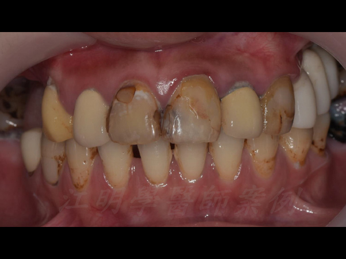 美白貼片治療效果