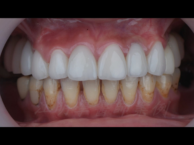 美白貼片治療效果