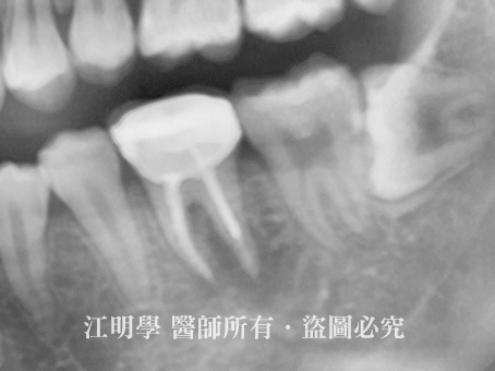 自體牙移植手術