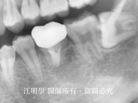 自體牙移植手術