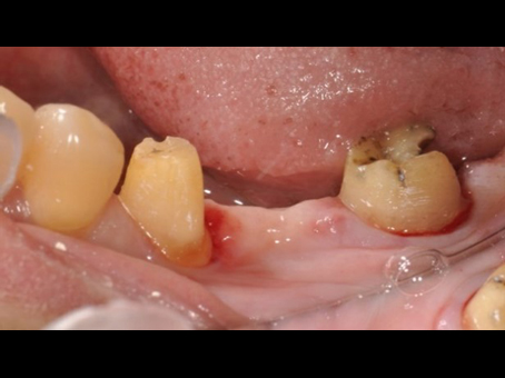 自體牙移植手術