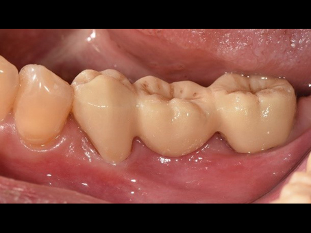 自體牙移植手術