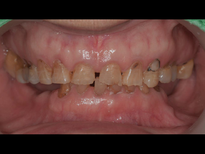 活動式假牙案例