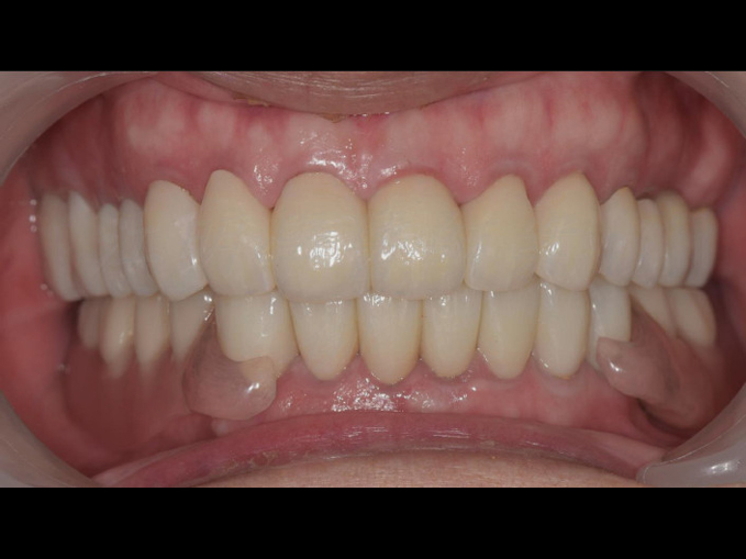 活動式假牙案例