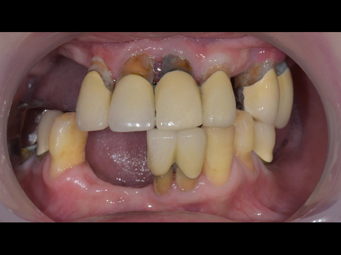 全口重建-All on 4