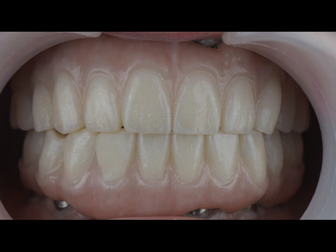 全口重建-All on 4