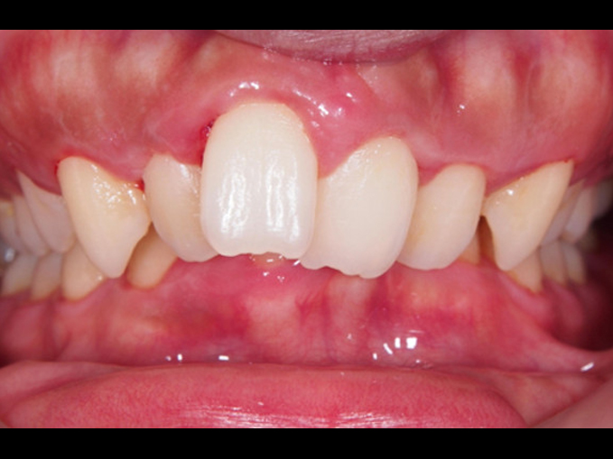 深咬、嚴重不整齊、笑齦、不拔牙-隱適美