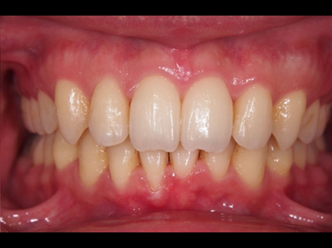 深咬、嚴重不整齊、笑齦、不拔牙-隱適美