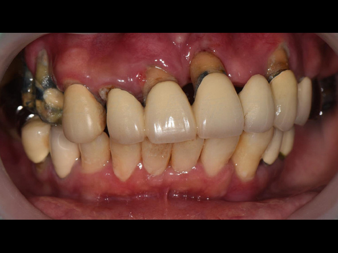 全口重建-All on 4