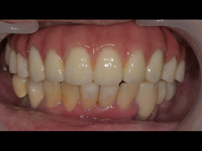 全口重建-All on 4