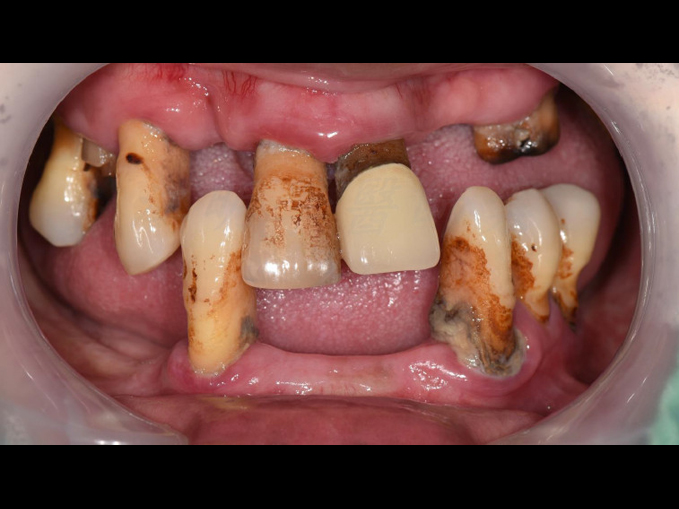 全口重建-All on 4