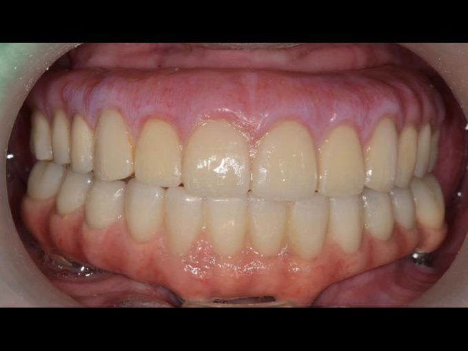 全口重建-All on 4