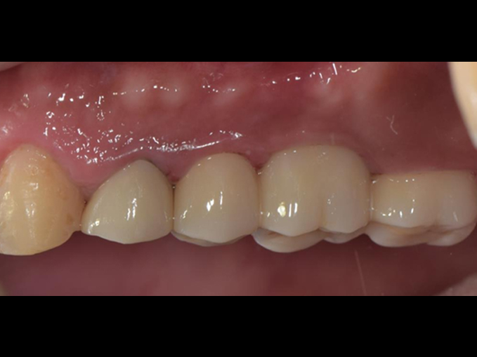 牙橋修復治療