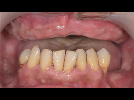 活動式假牙案例