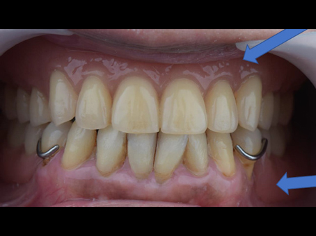 活動式假牙案例