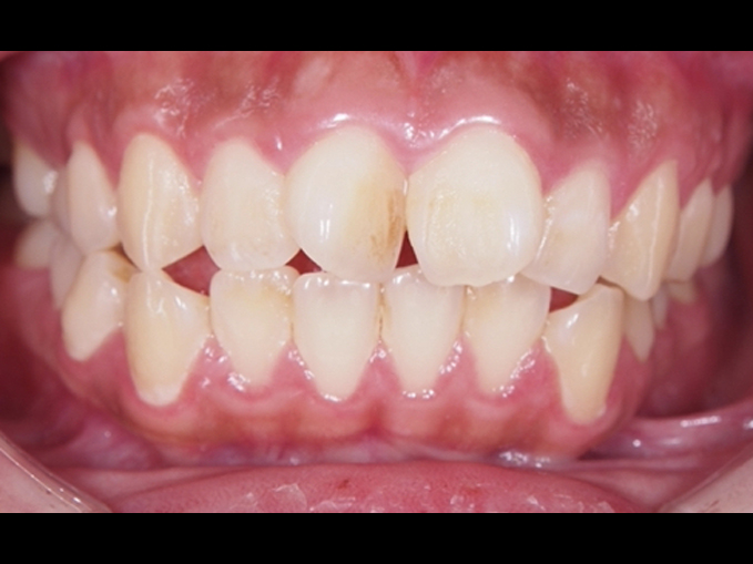 暴牙、唇閉合不全-拔牙