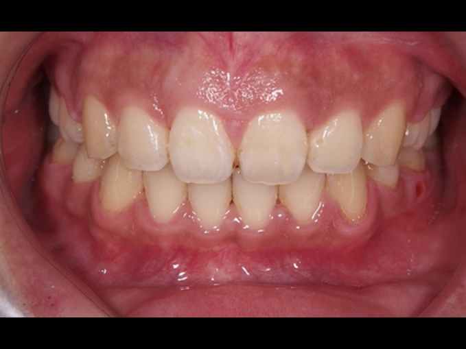 暴牙、唇閉合不全-拔牙