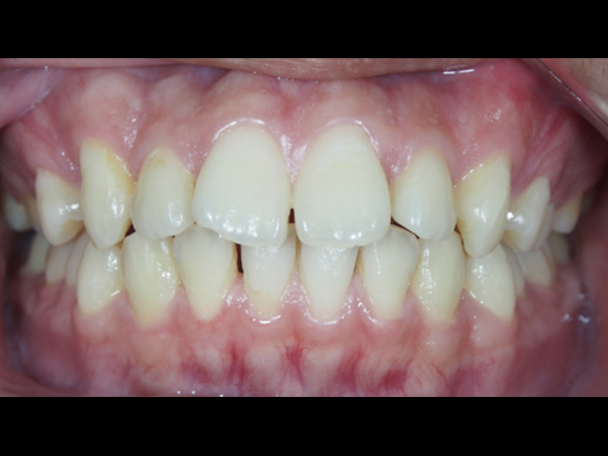 輕微暴牙、齒縫-不拔牙