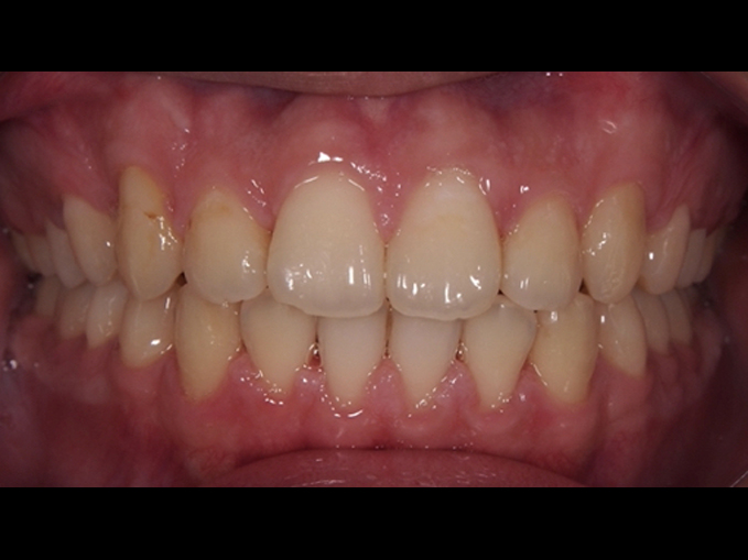 輕微暴牙、齒縫-不拔牙