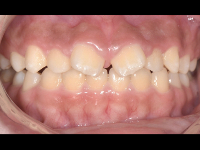 暴牙、厚唇案例