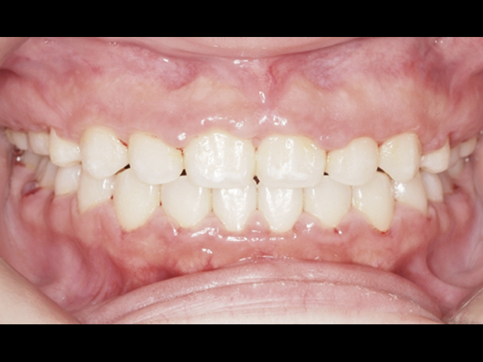 暴牙、厚唇案例