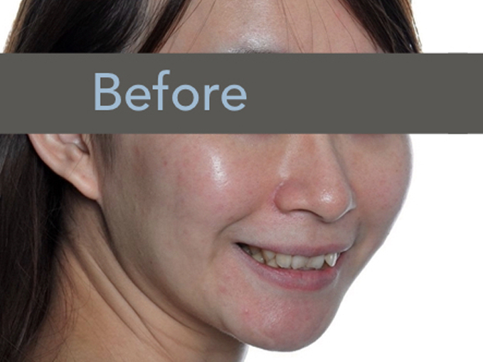 排列不整齊、深咬、不拔牙-隱適美