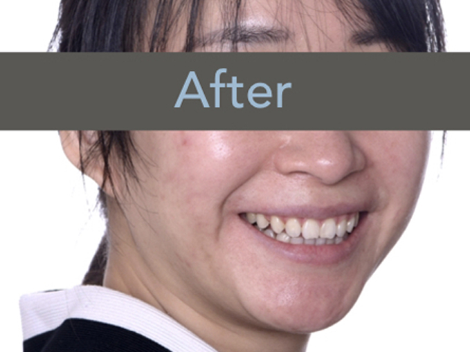 排列不整齊、深咬、不拔牙-隱適美