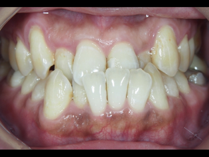 成人矯正戽斗案例-隱適美