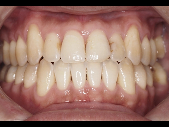 成人矯正戽斗案例-隱適美