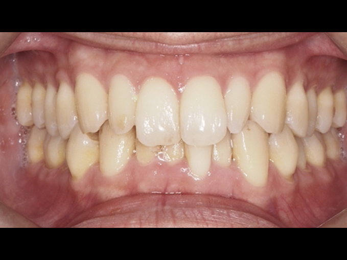 釘狀齒、拔下門牙-隱適美