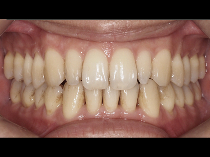 釘狀齒、拔下門牙-隱適美