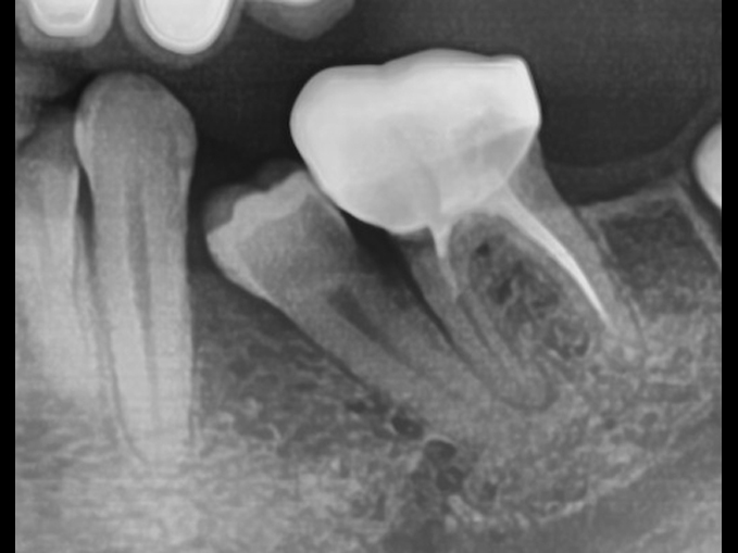 植牙前的局部矯正