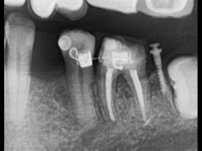 植牙前的局部矯正