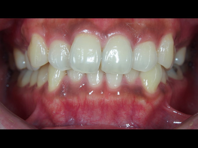 排列不整齊、不拔牙-隱適美