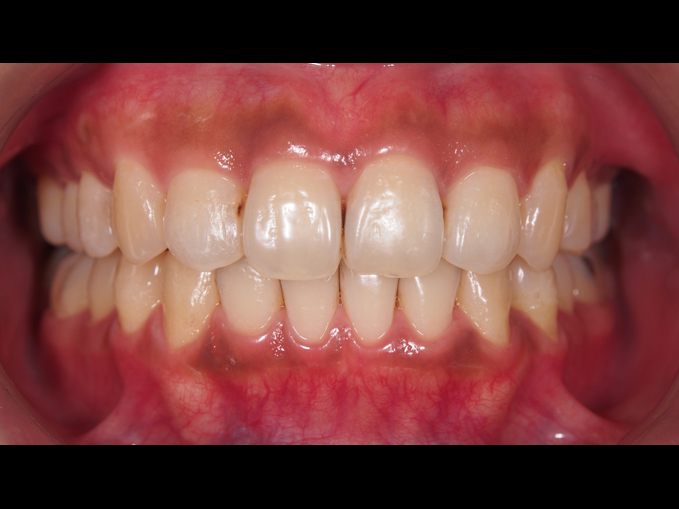 排列不整齊、不拔牙-隱適美