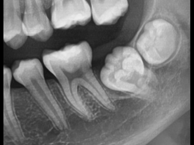 第二大臼齒埋伏齒