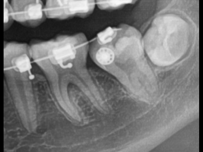 第二大臼齒埋伏齒