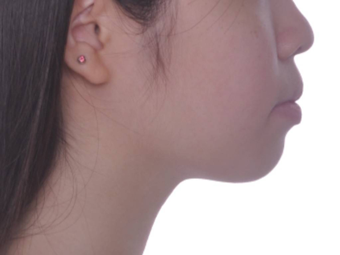 暴牙、唇閉合不全-拔牙