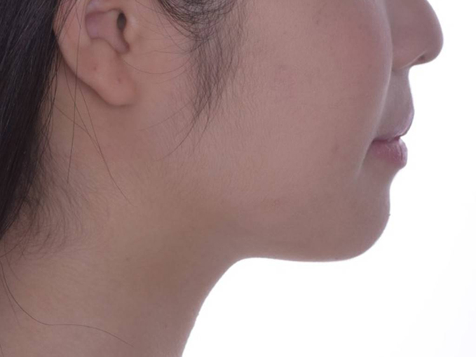 暴牙、唇閉合不全-拔牙