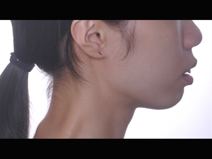 暴牙、拔牙案例