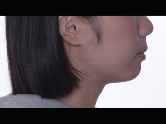 暴牙、拔牙案例