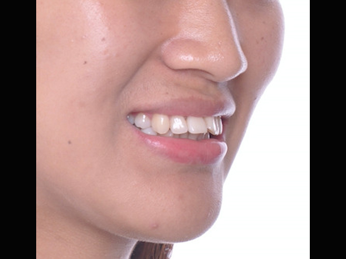 暴牙、智齒取代、拔牙-隱適美