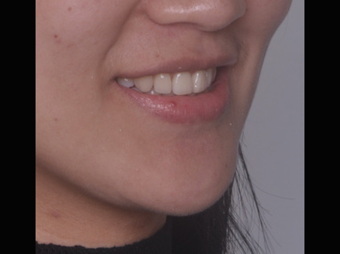 暴牙、智齒取代、拔牙-隱適美