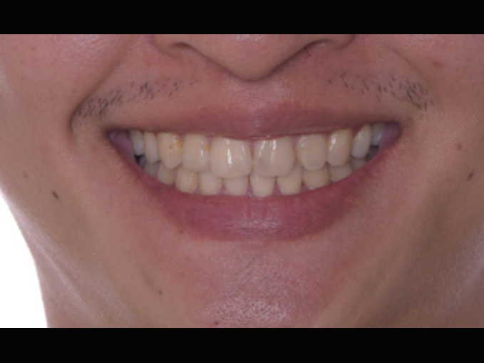 不整齒、拔牙、智齒取代-隱適美