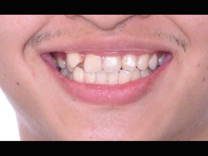 不整齒、拔牙、智齒取代-隱適美