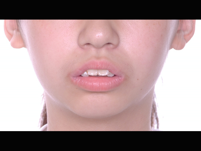 改臉型、門牙凸出、不整齊、暴牙-隱適美