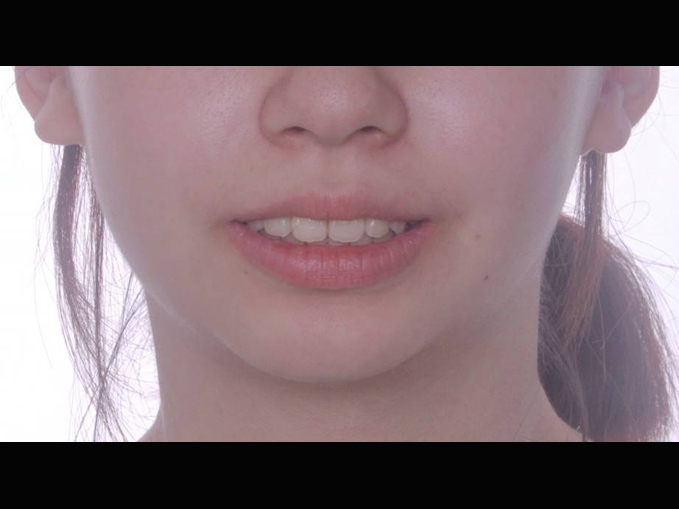 改臉型、門牙凸出、不整齊、暴牙-隱適美