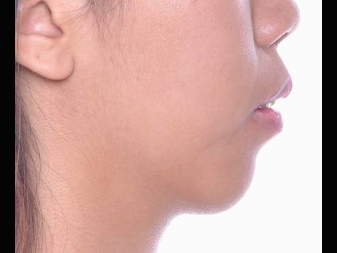 開咬、暴牙、不整齊、拔牙