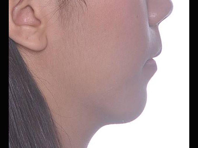 開咬、暴牙、不整齊、拔牙